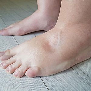 Miért kell cukorbetegként odafigyelni a lábápolásra?