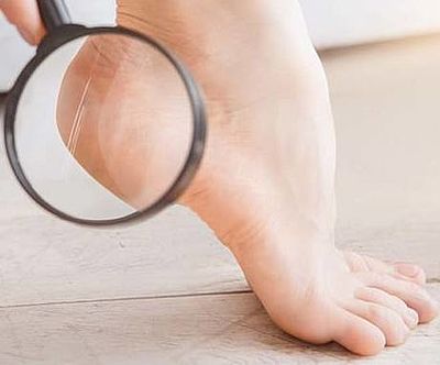 Cukorbeteg lábápolás | Allpresan - innováció a száraz és problémás bőrre